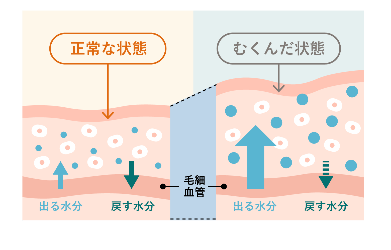 正常な状態とむくんだ状態の肌の断面図